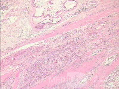 Gruczolakorak wpustu i dna żołądka z komórkami sygnetowatymi (19 z 25)