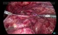 Laparoskopowa salpingektomia lewostronna z uwalnianiem zrostów z powodu wodniaka jajowodu - część 4