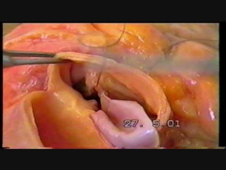 Całkowicie autologiczna rekonstrukcja zastawki aortalnej metodą opracowaną przez Doktora Vahe Gasparyan