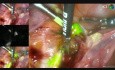 Laparoskopowa procedura węzła wartowniczego w przypadku raka endometrium z użyciem zieleni indocyjaninowej