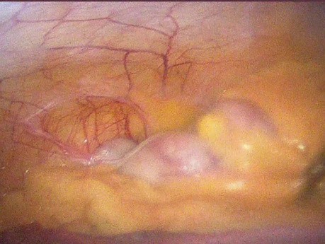 Ostre zapalenie wyrostka robaczkowego w ciąży z prawostronną skośną przepukliną pachwinową i wcześniejszą laparoskopową cholecystektomią (usunięcie pęcherzyka żółciowego)