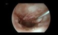 Endoskopowa tympanoplastyka i ossikuloplastyka w przewlekłym ropnym zapaleniu ucha środkowego
