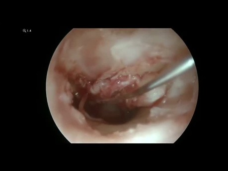 Endoskopowa tympanoplastyka i ossikuloplastyka w przewlekłym ropnym zapaleniu ucha środkowego
