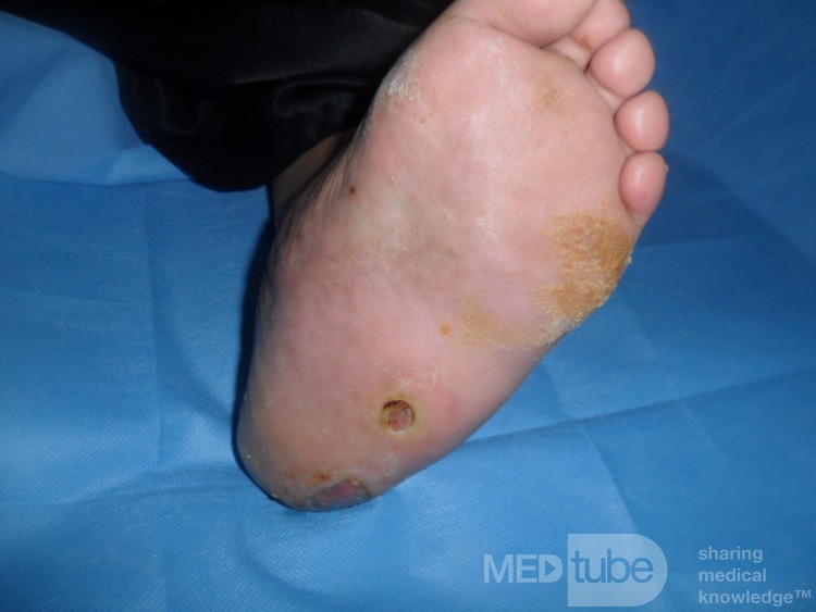 Stopa neuroartropatyczna w cukrzycy