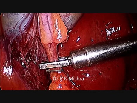 Cholecystektomia laparoskopowa