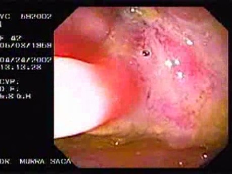 Choroba Leśniowskiego - Crohna - endoskopia (4 z 28)