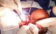 Przepuklina oponowa u 18-letniego pacjenta