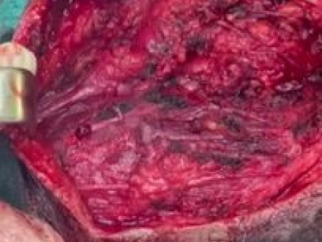 Parotidektomia - usunięcie ślinianki przyusznej