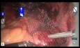 Sakrocerwikopeksja wspomagana robotem przy użyciu dwukierunkowego szwu kolczastego Quill®
