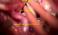 Anévrisme Complexe de l'Artère Carotide Interne - Traitement Exoscopique Microchirurgical par Clippage/Oblitération 