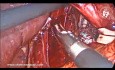 Laparoskopowa naprawa wślizgowej przepukliny rozworu przełykowego