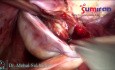Obustronne torbiele endometrialne (czekoladowe) z guzkami odbytniczo-pochwowymi