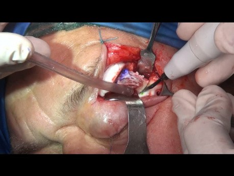 Pierwotna rekonstrukcja z implantem PEEK malformacji żył śródkościa bocznego brzegu oczodołu