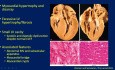 Echokardiograficzna ocena kardiomiopatii przerostowej (HCM)