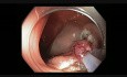 Kolonoskopia - guz LST - trudna resekcja