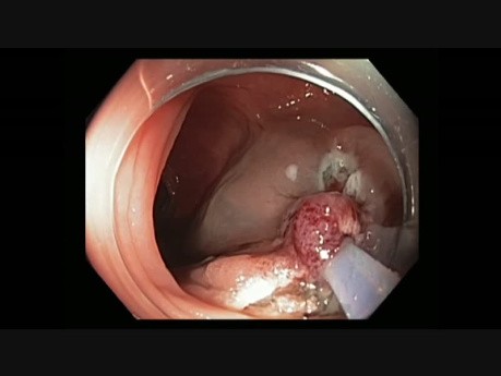Kolonoskopia - guz LST - trudna resekcja