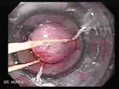Ostre krwawienie z górnego odcinka przewodu pokarmowego - 2 dni po założeniu podwiązki - opaskowanie żylaków, część 2
