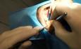 Zabieg implantacji w szczęce