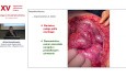 Krytyczna utrata długości jelita - następstwa krótko- i długoterminowe