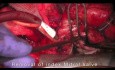 Ponowna operacja zastawki aortalnej i mitralnej 