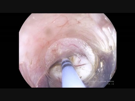 Tunelowa endoskopowa resekcja guza podśluzówkowego połączenia przełykowo-żołądkowego - STER
