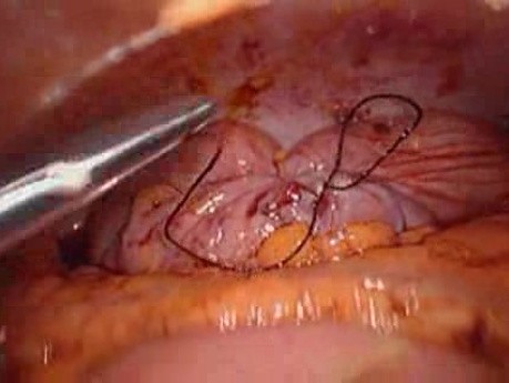 Perforacja okrężnicy z zapaleniem otrzewnej - laparoskopia (20 z 46)