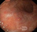 Nietypowy obraz polipów dna i trzonu żołądka w endoskopii. Chromoendoskopia. NET (2/6)