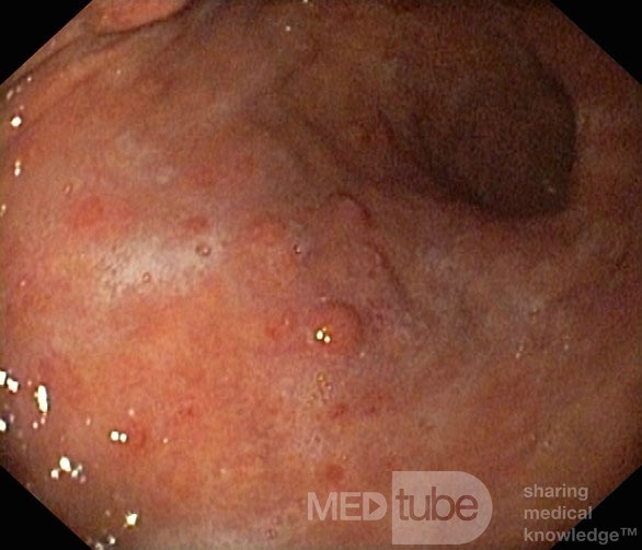 Nietypowy obraz polipów dna i trzonu żołądka w endoskopii. Chromoendoskopia. NET (2/6)