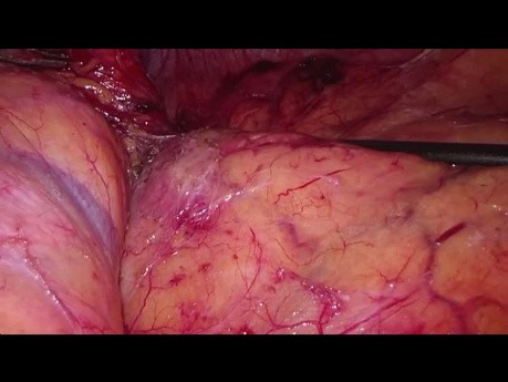 Laparoskopowa przezotrzewnowa adrenalektomia lewostronna z powodu przerzutu niedrobnokomórkowego raka płuca (NSCLC) 