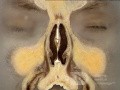 Anatomia nosa i zatok przynosowych w przekroju czołowym - przekrój 2