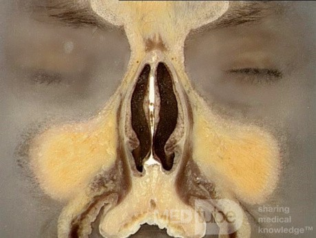 Anatomia nosa i zatok przynosowych w przekroju czołowym - przekrój 2