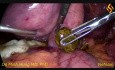 Laparoskopowa cholecystektomia, usunięcie złogów z przewodu żółciowego wspólnego 