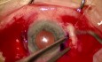 Witrektomia pars plana 25G + implantacja sztucznej soczewki wewnątrzgałkowej Soleko Carlevale IOL techniką "kieszonki twardówkowej"