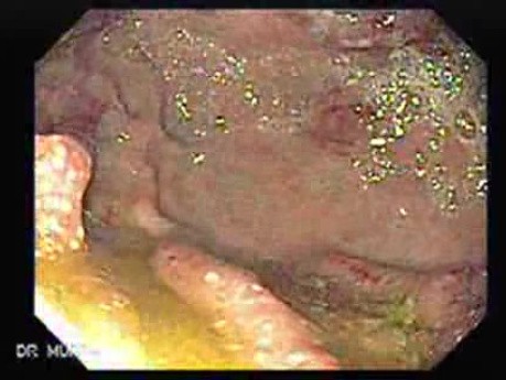 Rak jajnika z przerzutami do żołądka i dwunastnicy - pogrubienie ścian dwunastnicy