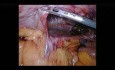 Operacja przepukliny przeponowej metodą laparoskopową