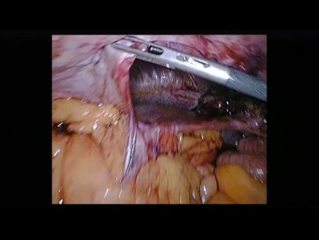 Operacja przepukliny przeponowej metodą laparoskopową