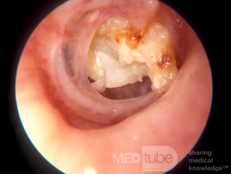 Perlak wydostający się po subtotalnej perforacji błony bębenkowej
