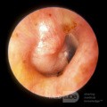 Pierwotny gruczolak ucha środkowego