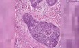 Rak płaskonabłonkowy - histopatologia - szyjka macicy