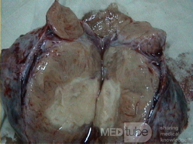 Arrhenoblastoma