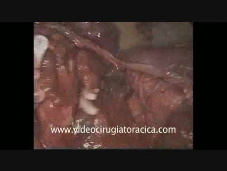 Wideotorakoskopowa anatomiczna resekcja języczka płuca przeprowadzona przez jeden port.