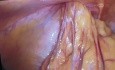 Laparoskopowa hernioplastyka przepukliny pachwinowo-mosznowej metodą przezbrzusznej przedotrzewnowej plastyki przepukliny (TAPP)