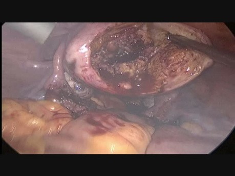 Resektohisteroskopia oraz laparoskopia z powodu polipa gruczolakowatgo jamy macicy