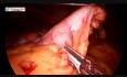 Jednoczesna resekcja rękawowa żołądka i operacja przepukliny pępkowej