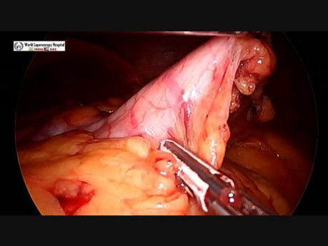 Jednoczesna resekcja rękawowa żołądka i operacja przepukliny pępkowej