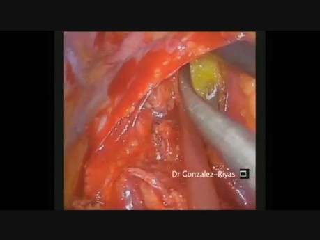 Dyssekcja przytchawiczych węzłów chłonnych metodą Single Port VATS