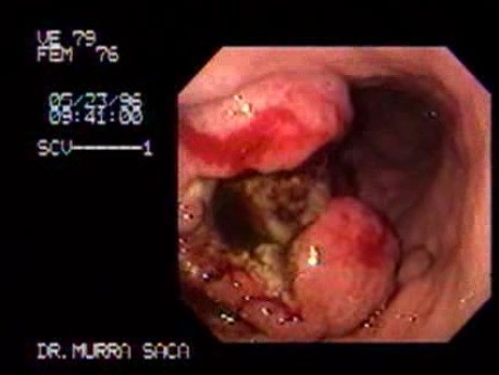 Rak gruczołowy trzonu żołądka (1 z 2)