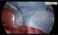 Laparoskopowa plastyka przepukliny pachwinowej z użyciem siatki 