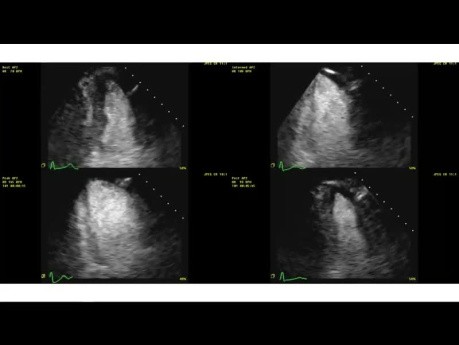 Zasady echokardiografii obciążeniowej w ocenie niedokrwienia i przypadki kliniczne