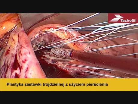 Małoinwazyjna, okołosutkowa operacja plastyki zastawki mitralnej i trójdzielnej oraz ablacji migotania przedsionków i zamknięcia uszka lewego przedsionka z użyciem torakskopii 3D